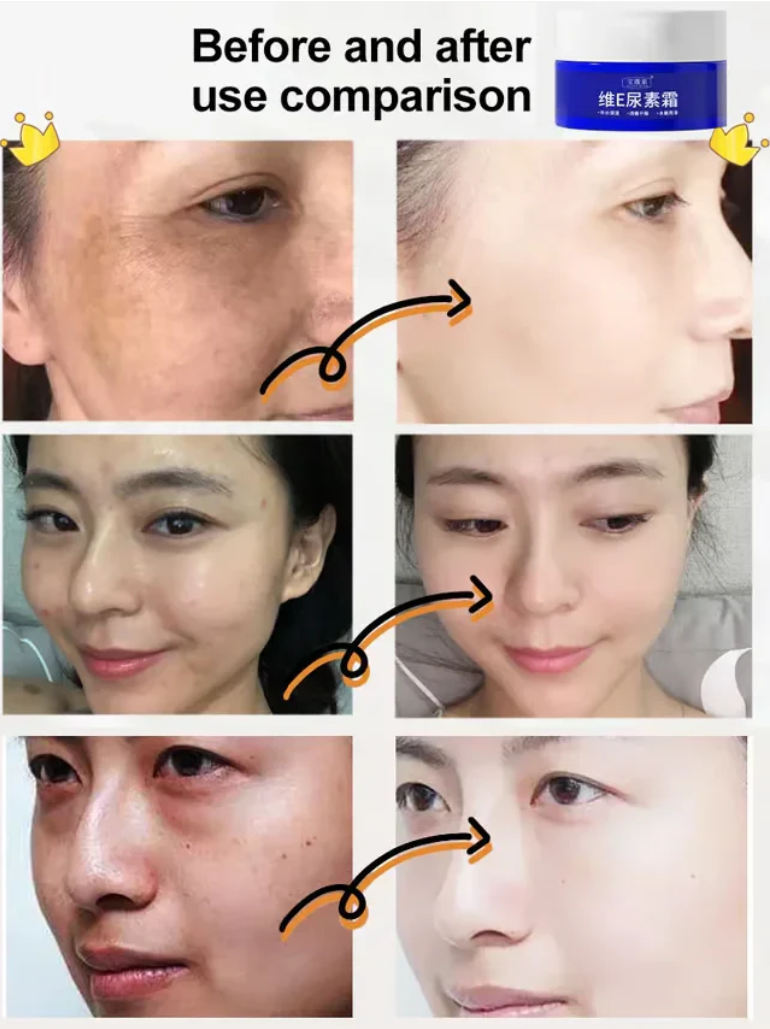 👨‍⚕️ Made and Shipped from US✅ Botox Bee Venom Wrinkle Removal Cream- LAST DAY 80% OFF