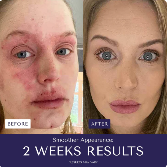 Eczema™ - Stop suffering from irritations or burns