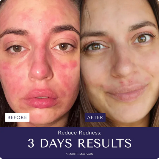 Eczema™ - Stop suffering from irritations or burns